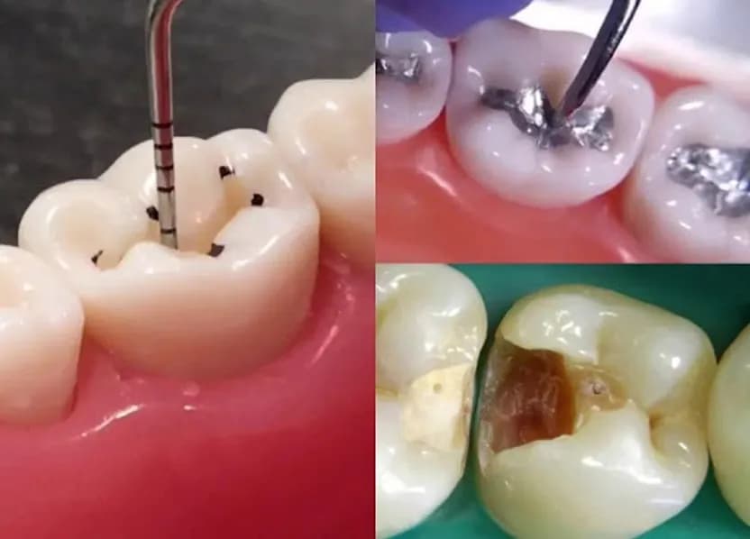 Dental cavity treatment bySmartsmile Dental Clinic