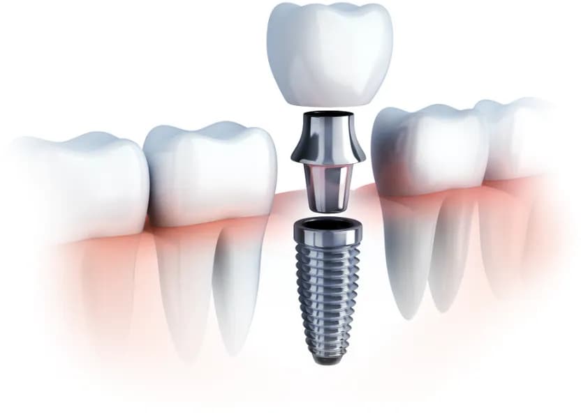 Dental Implants bySmartsmile Dental Clinic