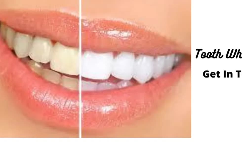 Tooth Whitening bySmartsmile Dental Clinic